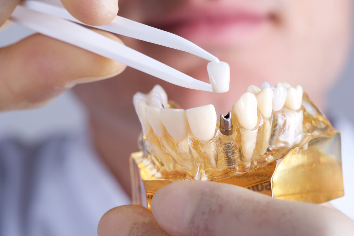 what are the benefits of dental implants