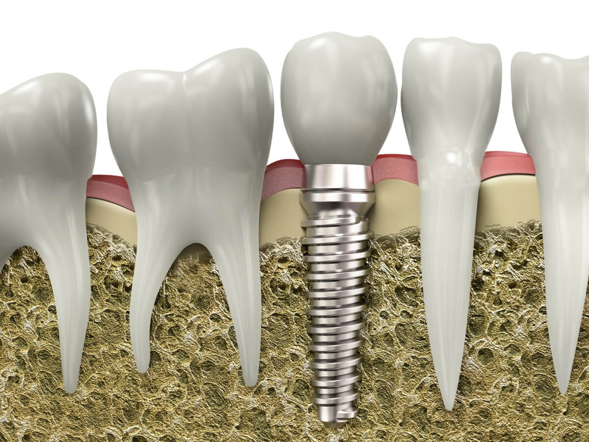 facts you should know about dental implants