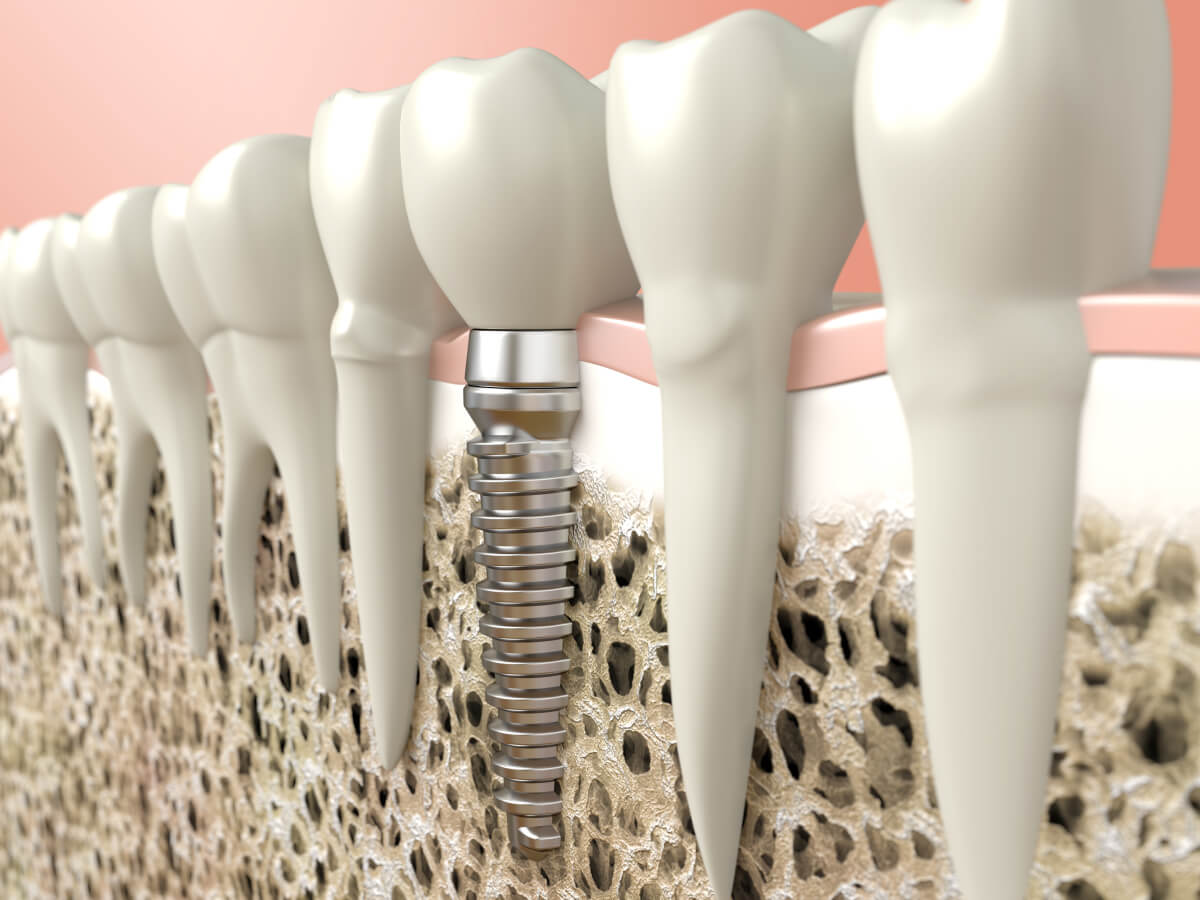 reasons why dental implants are so popular