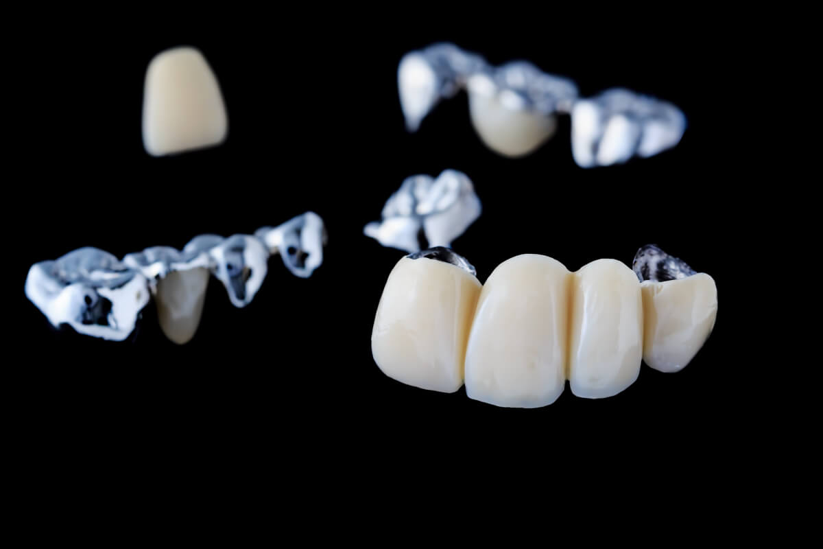 exploring your options: comparing different dental bridges