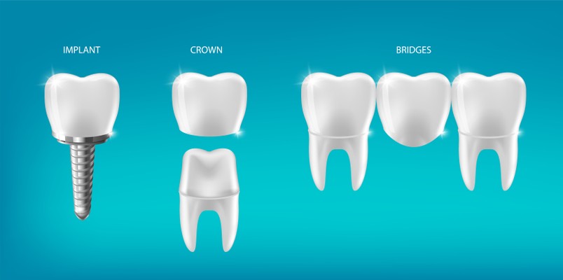 Dental Hygiene to Ensure Longevity of Crowns/Bridges/Implants