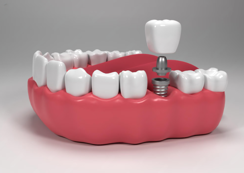 dental implants and jaw health