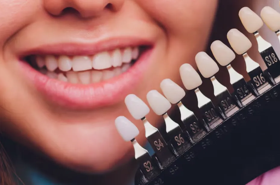 porcelain veneers aftercare