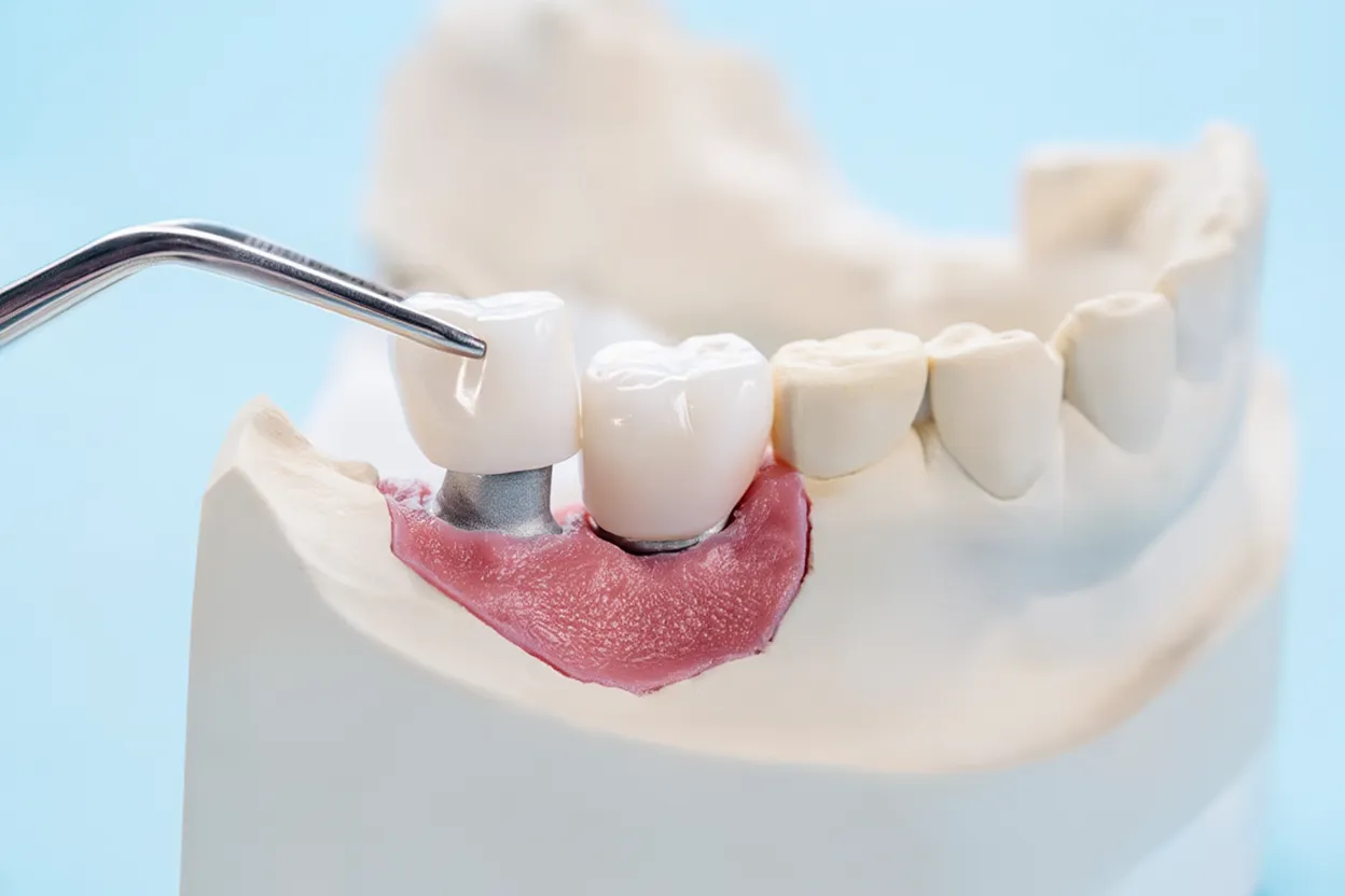porcelain vs zirconia vs metal dental crowns