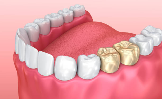 how long do dental crowns last and when should you replace them