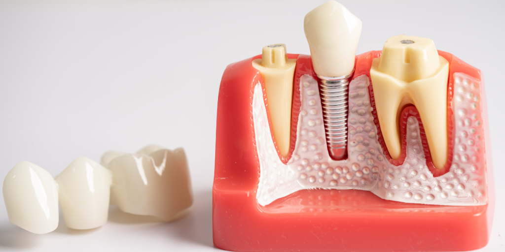 is a root canal worth it or should you extract the tooth